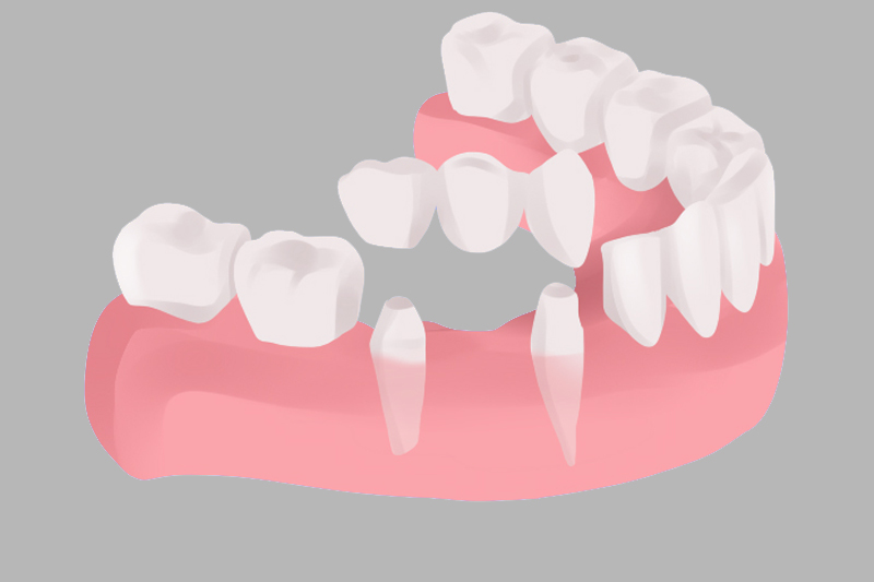 Quality & Affordable Dentist In Falcon 5907f5099e21dc6116a21ae4 crowns and bridges.webp