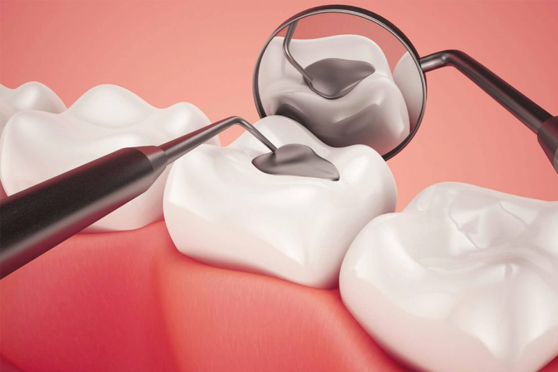 5907f6370446bd61038404b9 tooth coloured fillings.webp