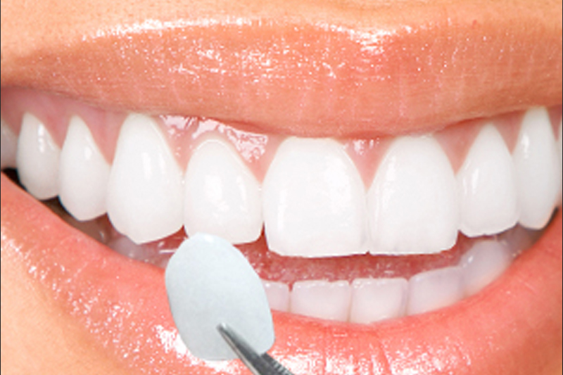 5907f6e66a3e0a5415bb4e89 veneers.webp