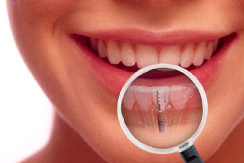 5907f8bb0e9ee73b902470e8 implants.webp