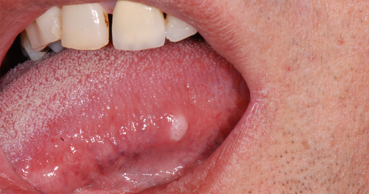 5fc09d04bd65e838e6789843 article imgs 0002 oral cancer.webp
