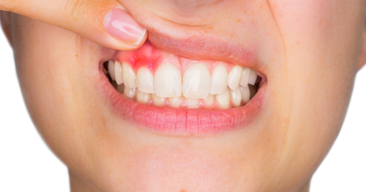 5fc09d18c77a4a4d746651ab article imgs 0001 gum disease.webp